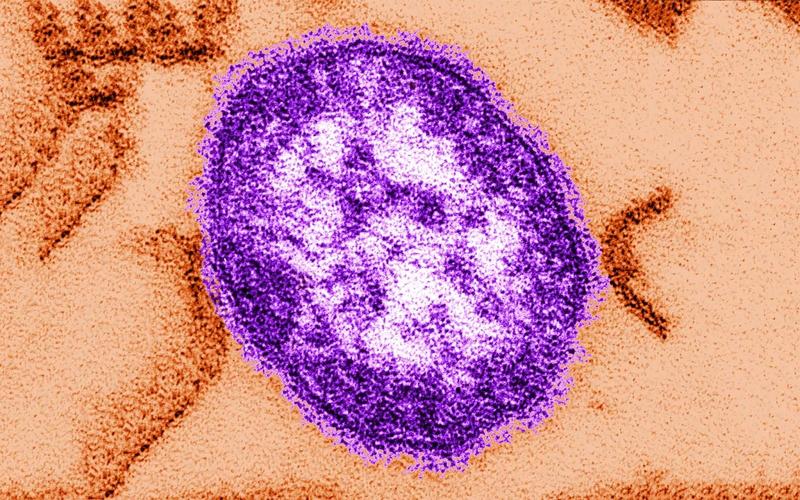 8 cases of measles diagnosed in Israel in past week, Health Ministry says