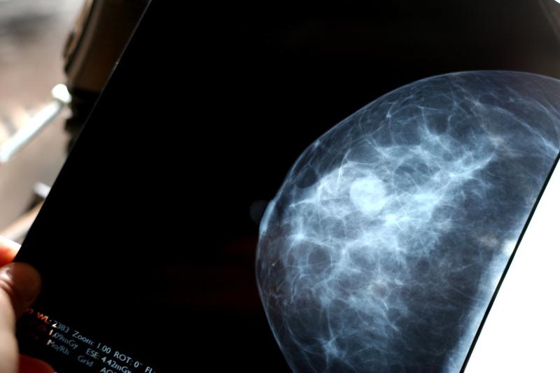 Tumore al seno: nuova molecola blocca le metastasi