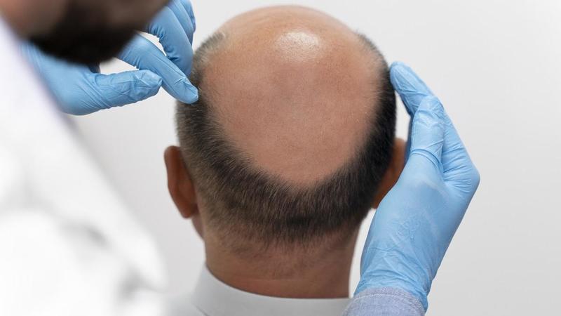 Revertir la alopecia