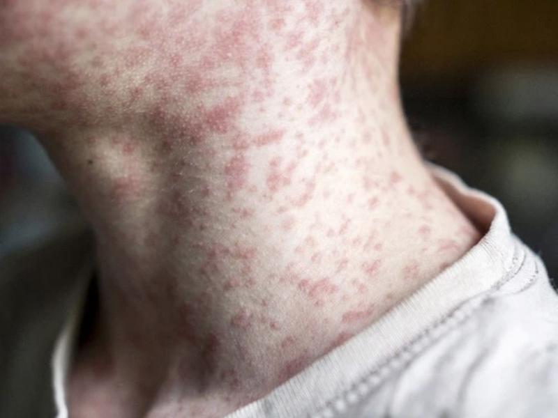 Opinion: Smith must encourage measles vaccinations to fight outbreak