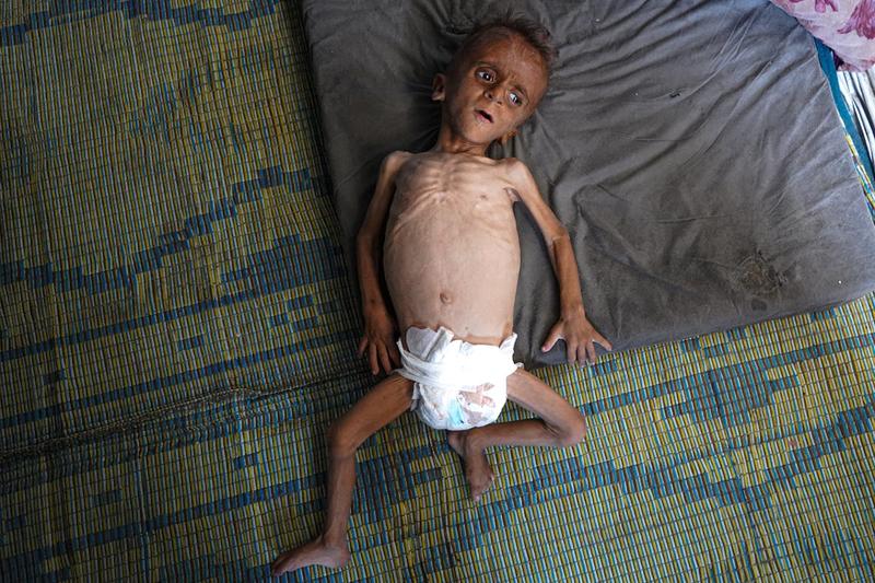 NYT Adds Sick Editors’ Note to Viral Photo of Child Starving in Gaza