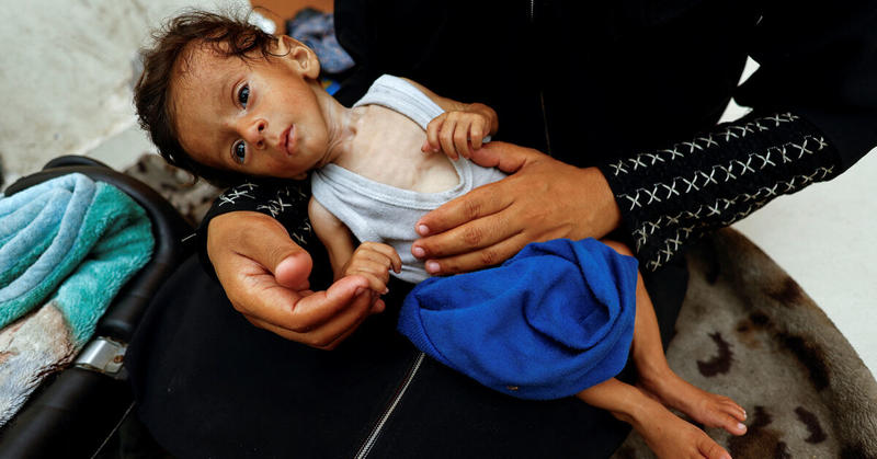Gaza father grieving loss of child to malnutrition scrambles to save siblings
