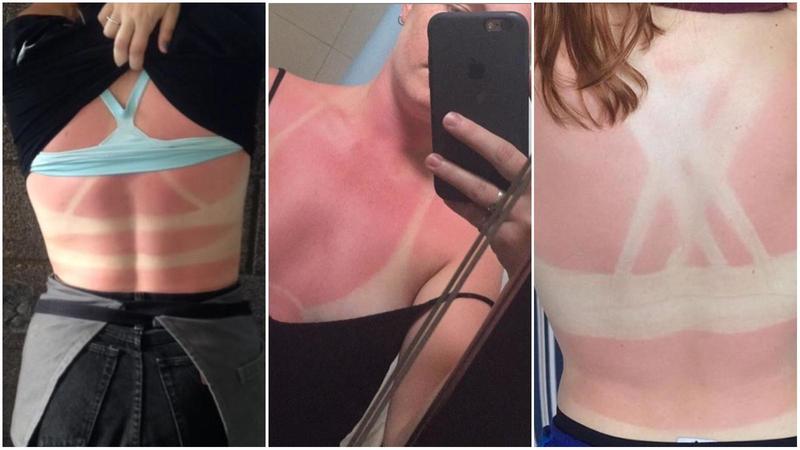 Abbronzatura selvaggia, il trend delle ustioni che spopola sui social. Il dermatologo: “È follia, si rischia il cancro”