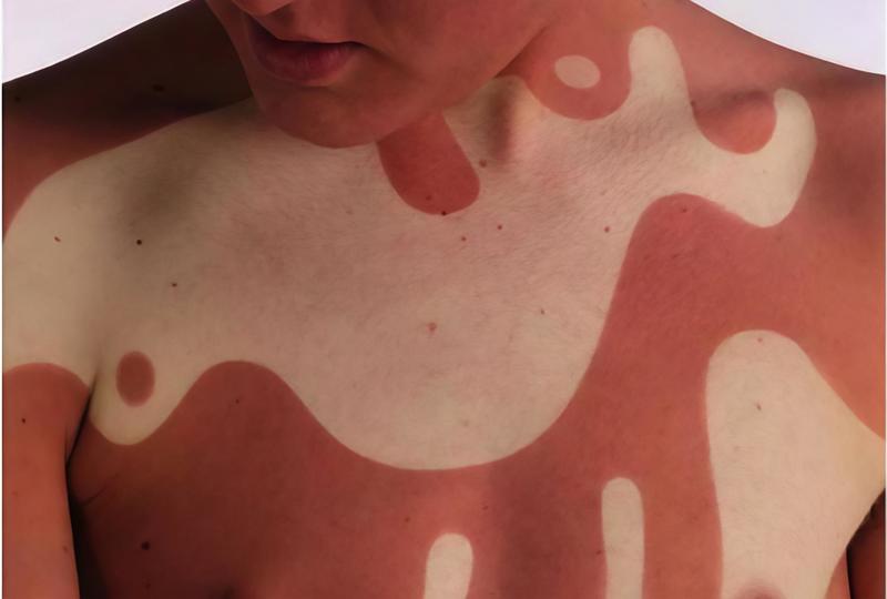 Travolti da un’insolita abbronzatura. La follia social di bruciarsi ‘ad arte’