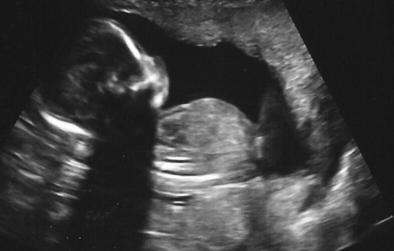 Misguided Compassion in the Abortion Debate