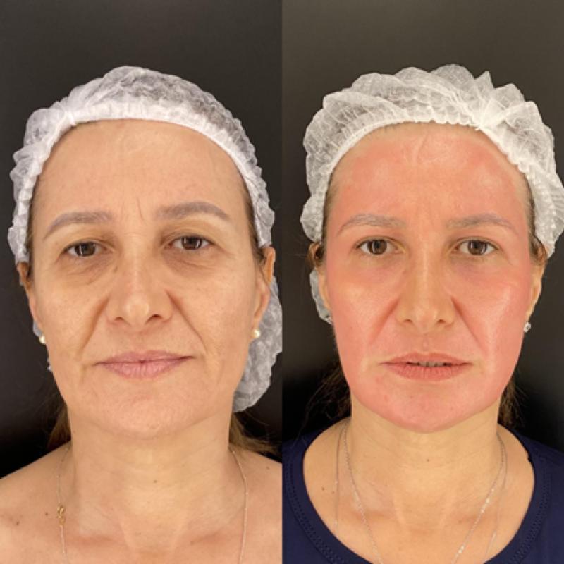 Pacientes estrangeiros desembarcam em Belo Horizonte em busca do APhen Peel® com o Dr. Lucas Miranda