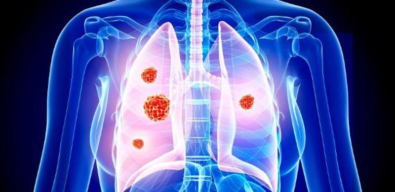 Câncer na pleura: médicos fazem quimioterapia aquecida na cirurgia robótica