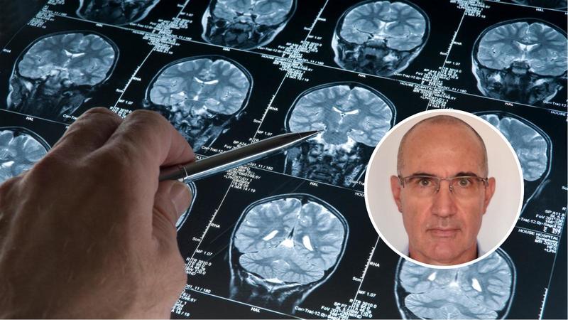 Il tumore al cervello si può combattere? Uno studio universitario dice di sì