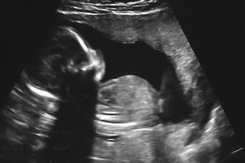 Infertility: Science, Politics, Money, and Morality