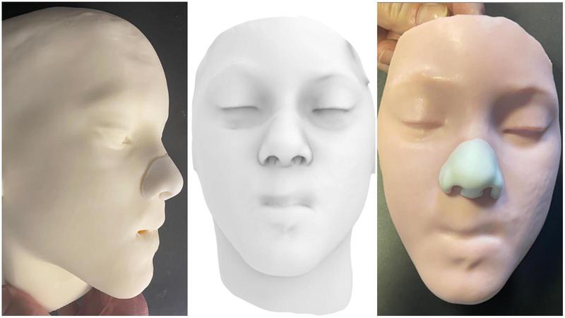 Bimbo di 10 anni senza naso e labbro: ricostruzione record al Bambino Gesù. “Pietra miliare nella chirurgia plastica pediatrica”