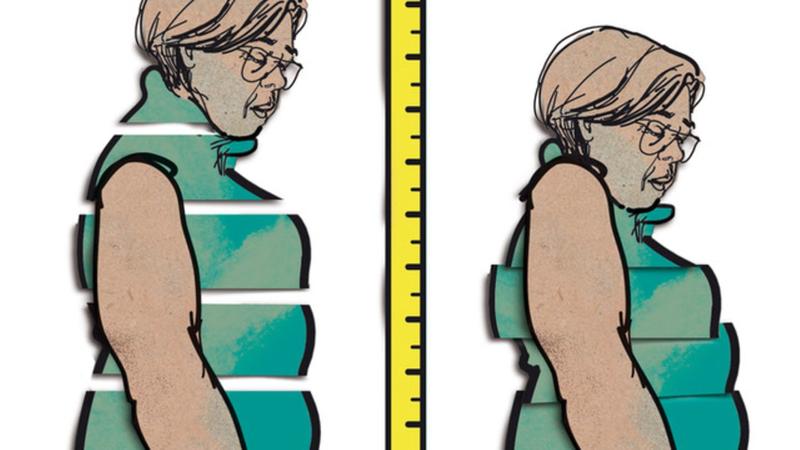 Eine Frau hat Wirbelbrüche. Dabei nimmt sie extra viel Vitamin D für die Knochen