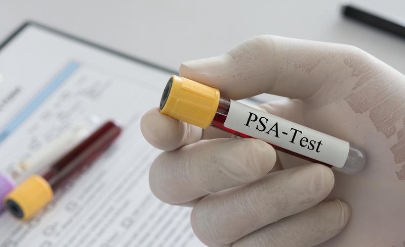 What’s wrong with ‘over-testing’ for prostate cancer? What’s wrong with ‘over-testing’ for prostate cancer?