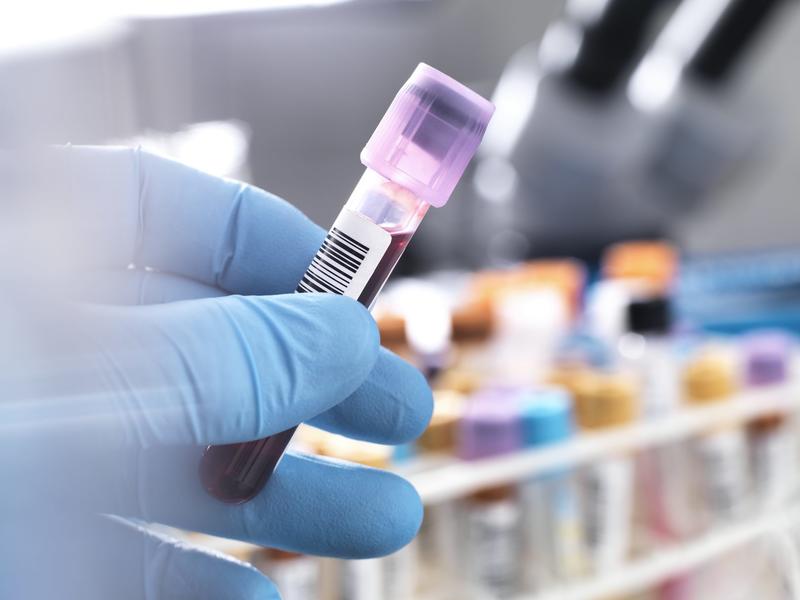 Can a new blood test really detect ME/CFS? An expert unpacks new research