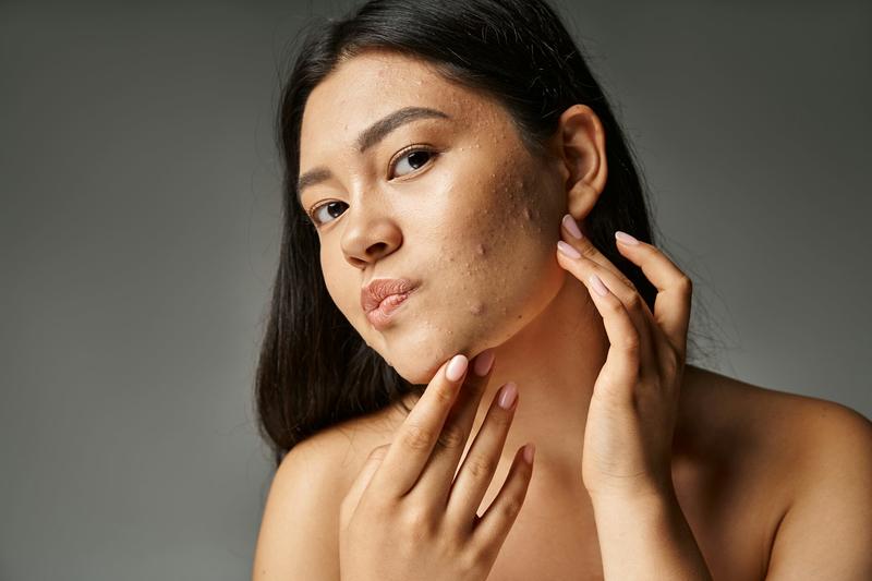 Acne: a GP’s guide to understanding and managing it