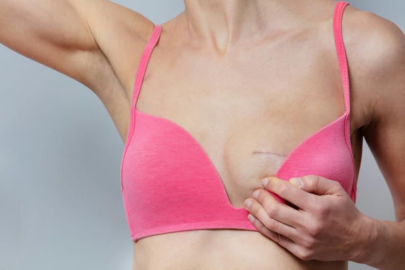 Cancer du sein : comment sont remboursés les produits de soutien ?