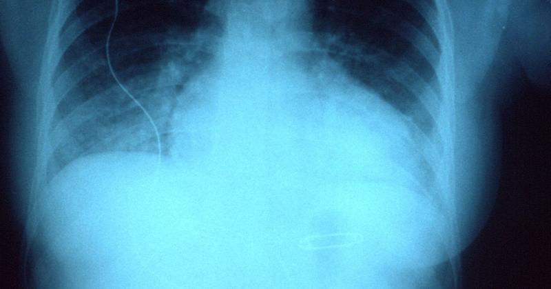 When Heart Failure Is Welcome News