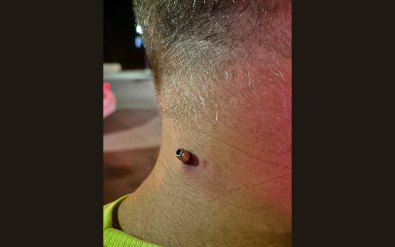 Stray bullet lodges in man’s neck, causing minor injuries Stray bullet lodges in man’s neck, causing minor injuries