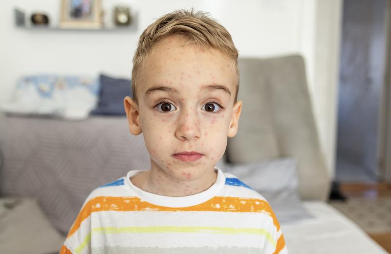 Can you get chickenpox twice? Or if you’re vaccinated? Experts answer 9 key questions Can you get chickenpox twice? Or if you’re vaccinated? Experts answer 9 key questions