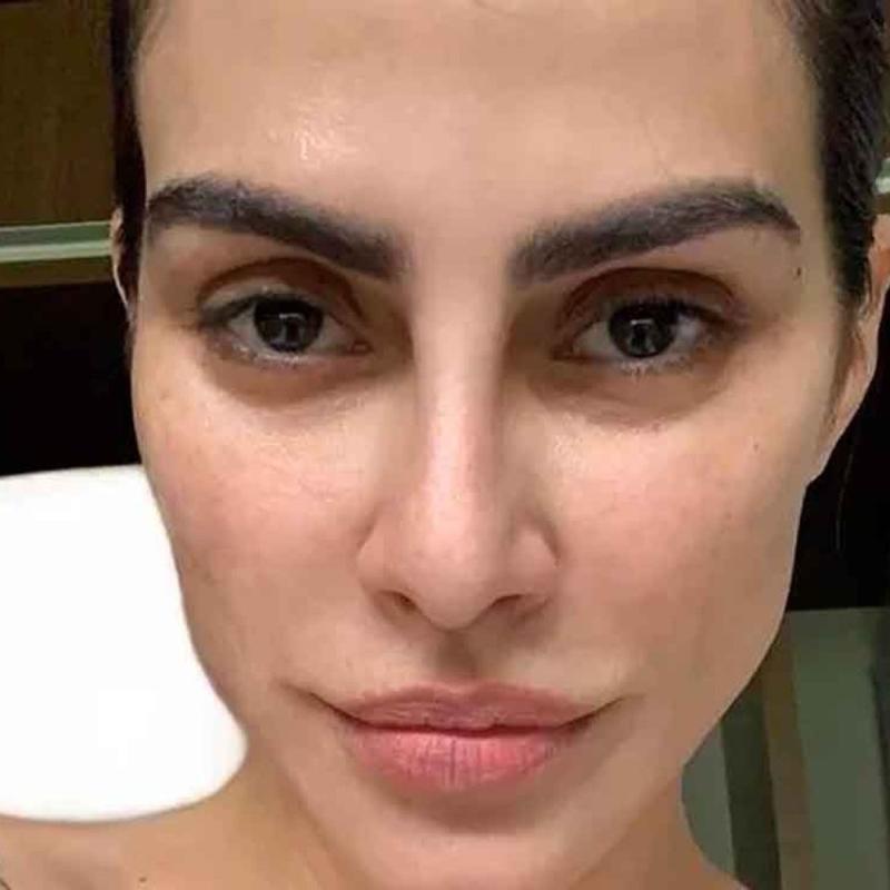 Como prevenir o melasma nesta época de calor