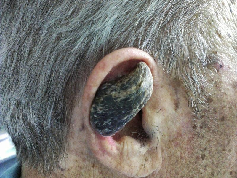 Why some humans grow horns Why some humans grow horns