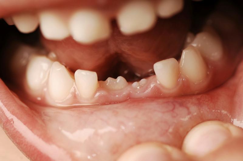 Why do people have baby teeth and adult teeth? Why do people have baby teeth and adult teeth?