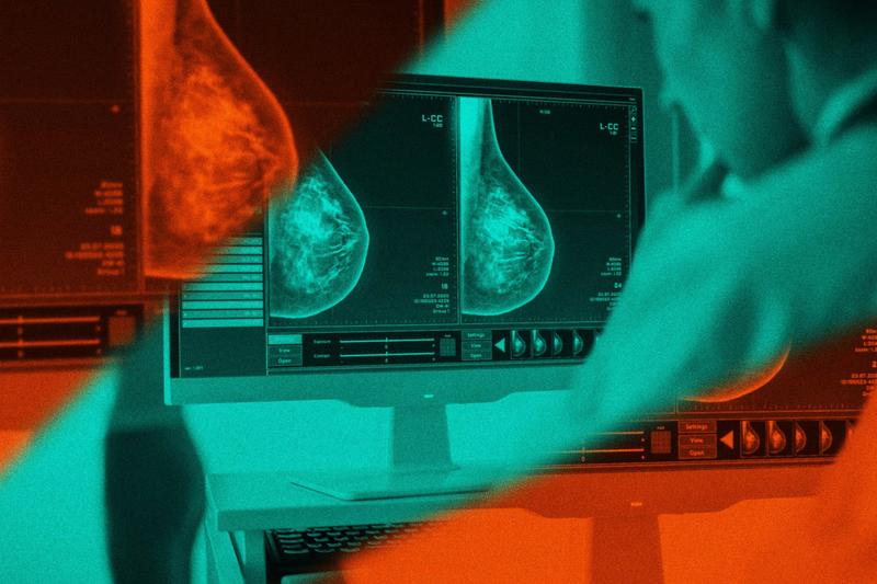 Immigrant Women More Exposed to Breast Cancer Risks At Work