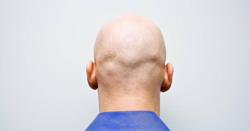 Trevor Laffan: You’ve heard about sexism and ageism...what about baldism?