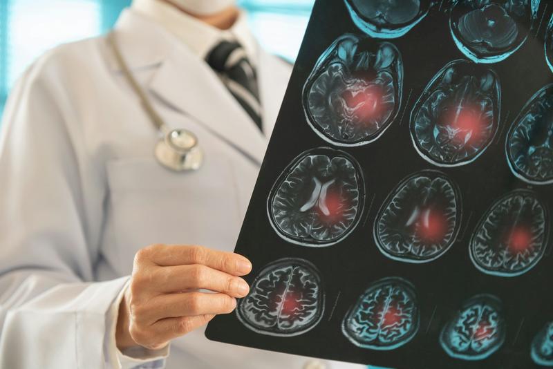 How stem cell therapy can regenerate brain tissue after a stroke