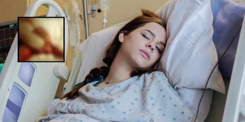 Woman has cyst removed and is shocked to learn it had teeth, hair, and maybe even an eyeball