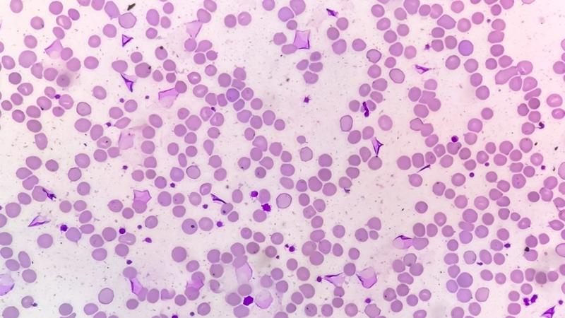 Revolucionarno otkriće: Nova terapija uništila vrstu raka koja je do sada bila neizlečiva Revolucionarno otkriće: Nova terapija uništila vrstu raka koja je do sada bila neizlečiva