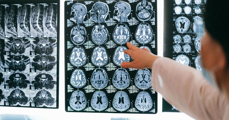 Left-Handedness and Brain Asymmetries: How Are They Linked?