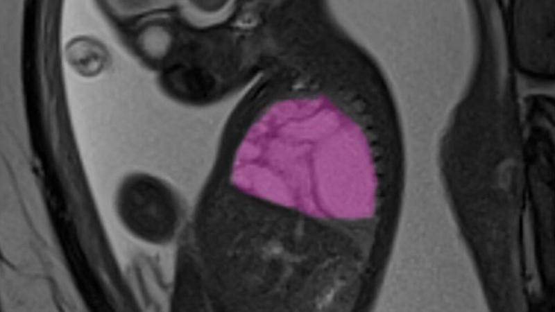 Operato in utero per una cisti gigante al polmone: il piccolo ora sta bene – Così i medici gli hanno salvato la vita