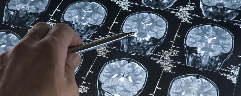 Chirurgia cerebrale, svolta hi-tech: una scansione 3D guida il bisturi